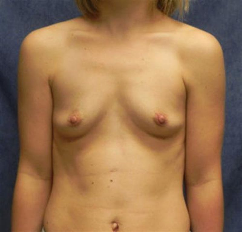 Breast Augmentation Before & After Gallery - Patient 206605 - Image 1
