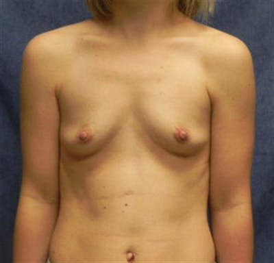 Breast Augmentation Before & After Gallery - Patient 206605 - Image 1