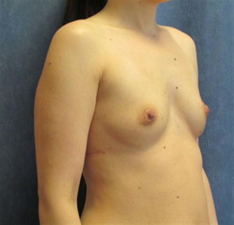 Breast Augmentation Before & After Gallery - Patient 302059 - Image 1