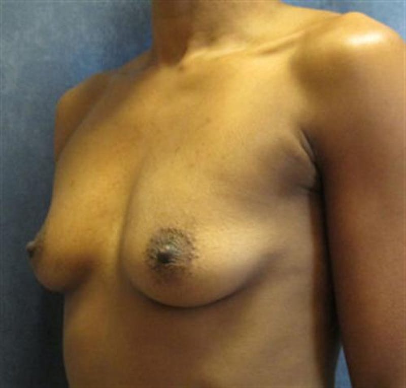 Breast Augmentation Before & After Gallery - Patient 145590 - Image 1