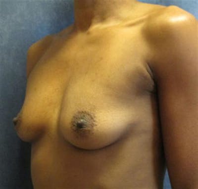 Breast Augmentation Before & After Gallery - Patient 145590 - Image 1