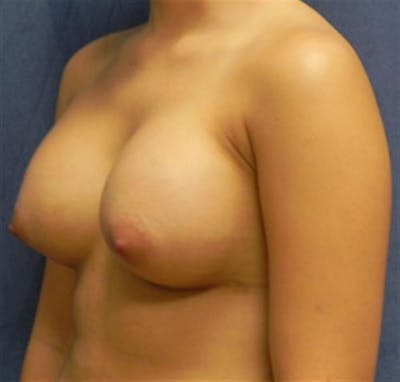 Breast Augmentation Before & After Gallery - Patient 157828 - Image 2