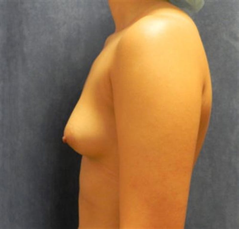 Breast Augmentation Before & After Gallery - Patient 157828 - Image 3