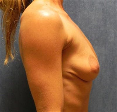 Breast Augmentation Before & After Gallery - Patient 966888 - Image 1