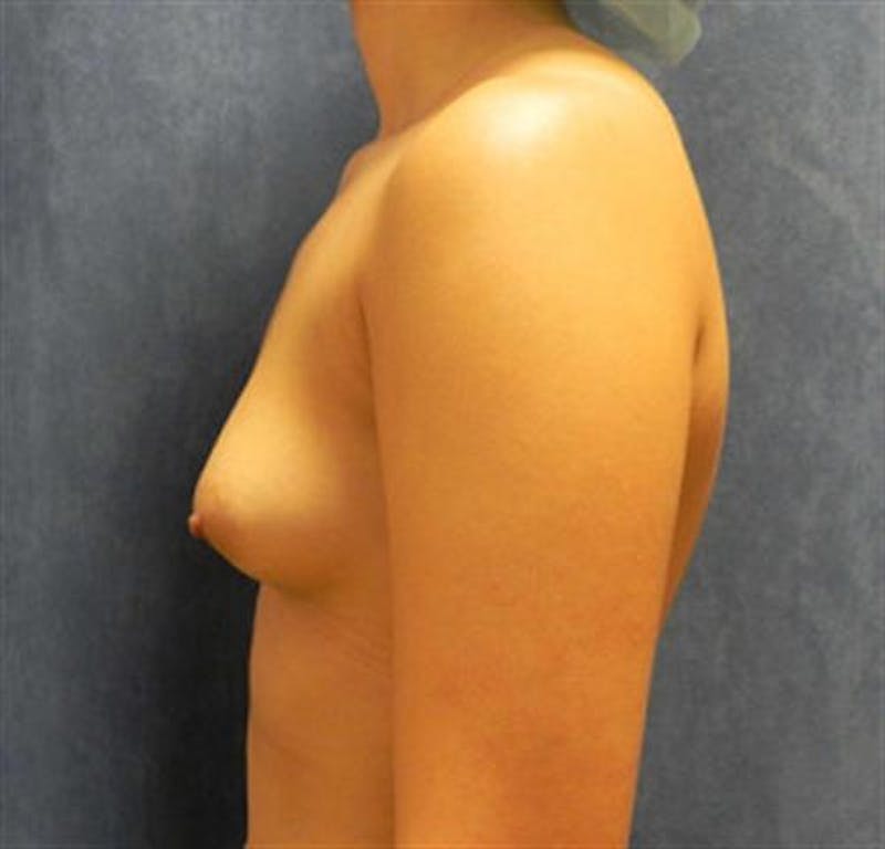 Breast Augmentation Before & After Gallery - Patient 263315 - Image 5