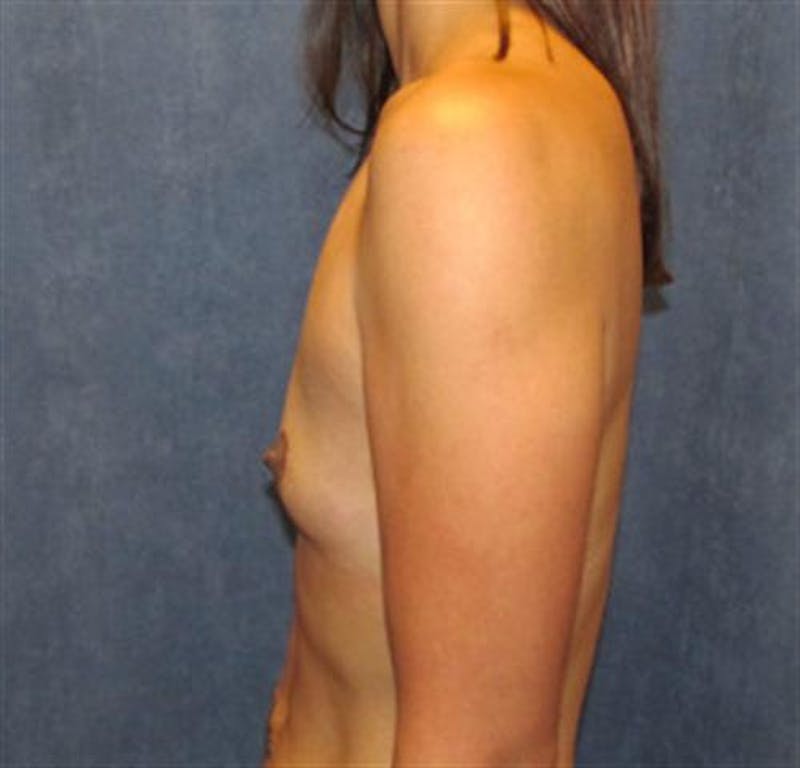 Breast Augmentation Before & After Gallery - Patient 427130 - Image 3
