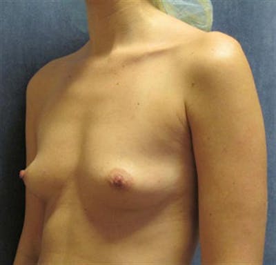 Breast Augmentation Before & After Gallery - Patient 870921 - Image 1