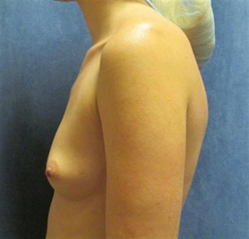 Breast Augmentation Before & After Gallery - Patient 870921 - Image 3