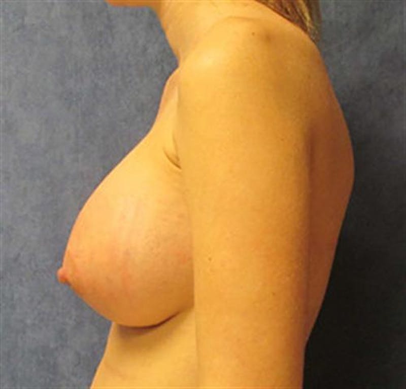 Breast Augmentation Before & After Gallery - Patient 870921 - Image 4