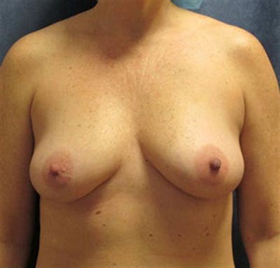 Breast Augmentation Before & After Gallery - Patient 339664 - Image 1