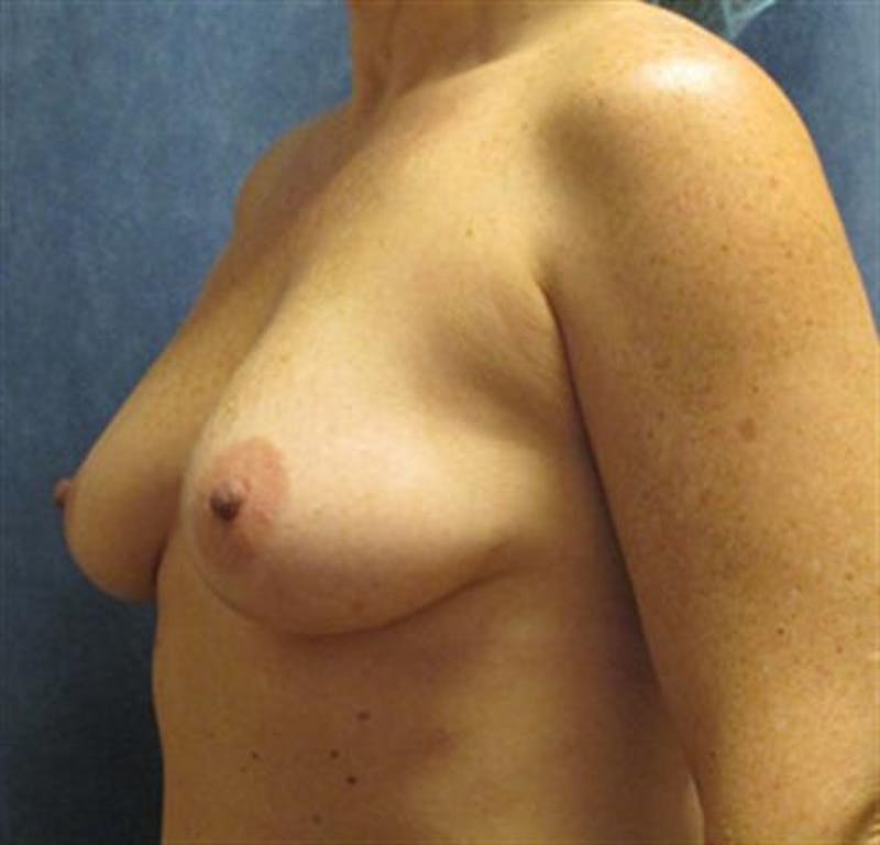 Breast Augmentation Before & After Gallery - Patient 339664 - Image 3