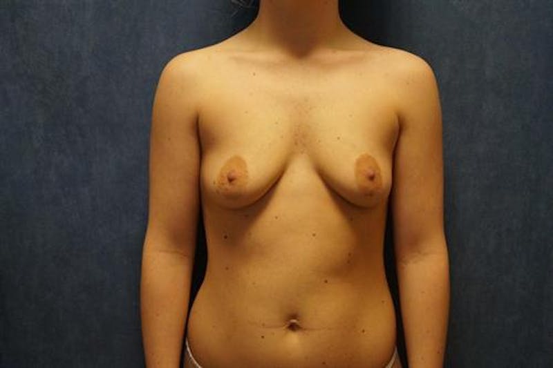 Breast Augmentation Before & After Gallery - Patient 407738 - Image 1