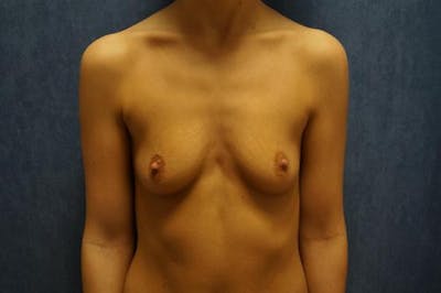 Breast Augmentation Before & After Gallery - Patient 158907 - Image 1