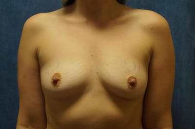 Breast Augmentation Before & After Gallery - Patient 212911 - Image 1