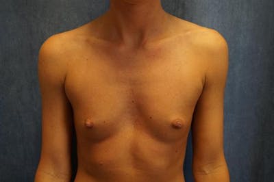 Breast Augmentation Before & After Gallery - Patient 904680 - Image 1