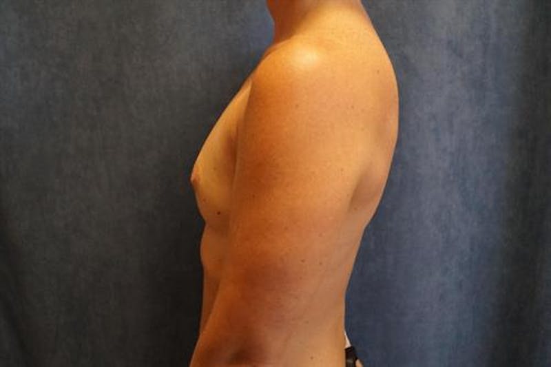 Breast Augmentation Before & After Gallery - Patient 130352 - Image 3