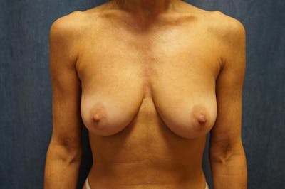 Breast Augmentation Before & After Gallery - Patient 347621 - Image 1