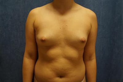 Breast Augmentation Before & After Gallery - Patient 404941 - Image 1