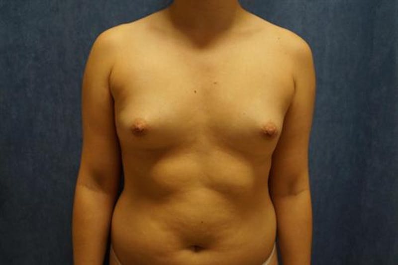 Breast Augmentation Before & After Gallery - Patient 404941 - Image 1