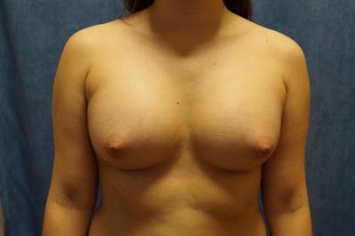 Breast Augmentation Before & After Gallery - Patient 404941 - Image 2
