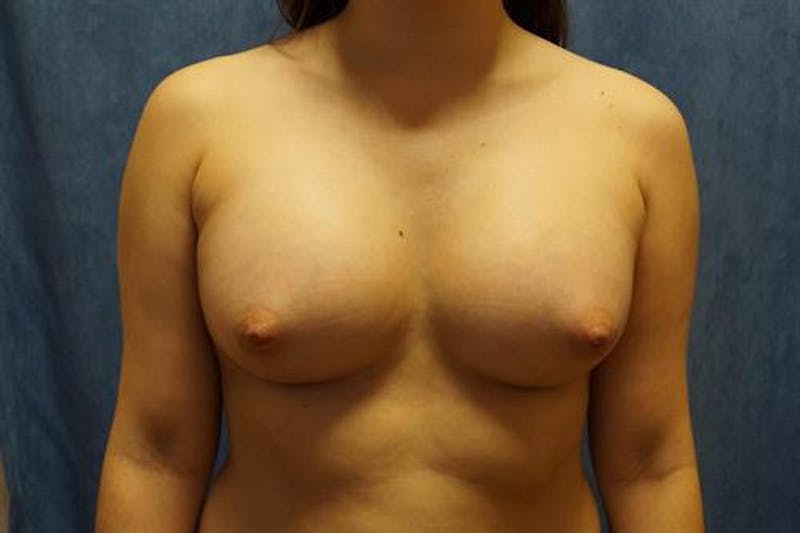 Breast Augmentation Before & After Gallery - Patient 404941 - Image 2