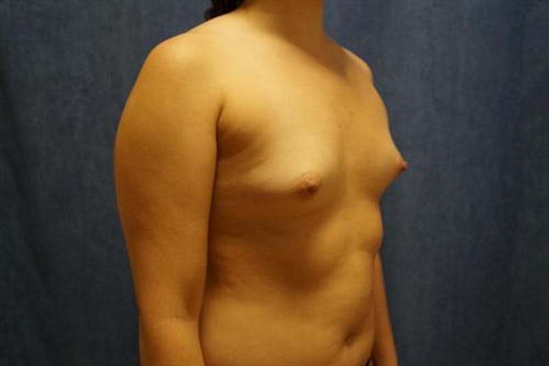 Breast Augmentation Before & After Gallery - Patient 404941 - Image 3