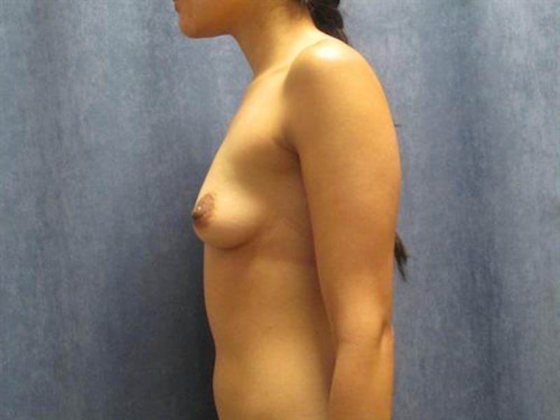 Breast Augmentation Before & After Gallery - Patient 292839 - Image 5