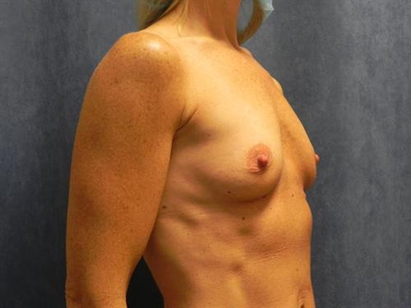 Breast Augmentation Before & After Gallery - Patient 280955 - Image 3