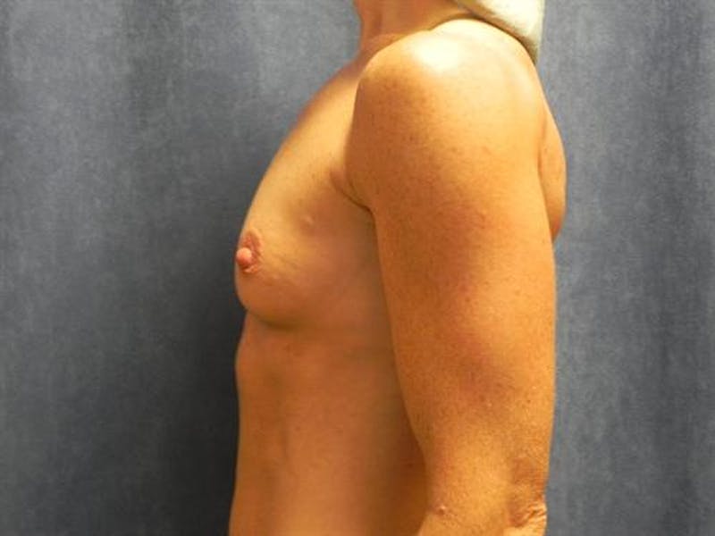 Breast Augmentation Before & After Gallery - Patient 280955 - Image 5
