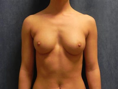 Breast Augmentation Before & After Gallery - Patient 227784 - Image 1