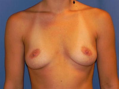 Breast Augmentation Before & After Gallery - Patient 131847 - Image 1