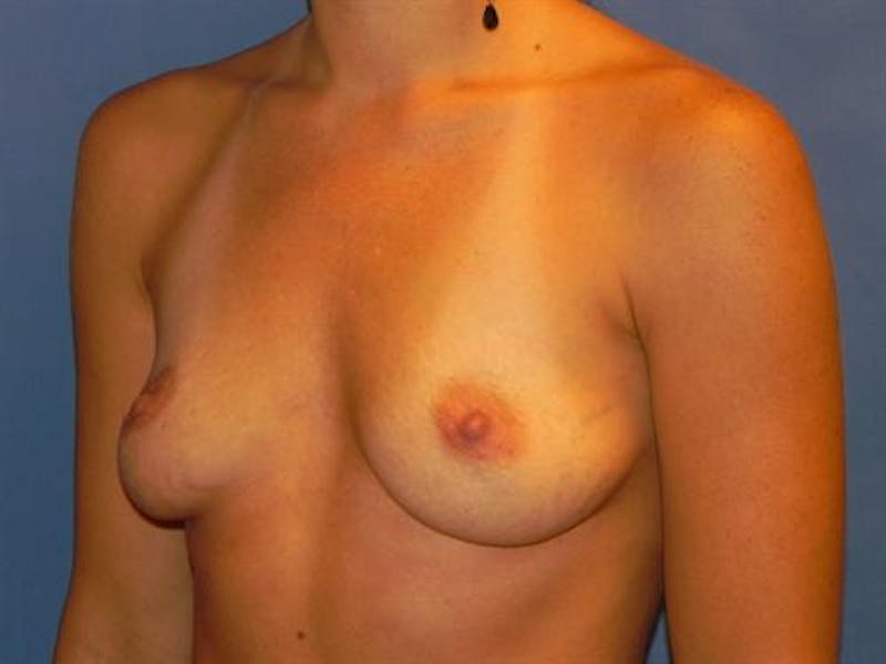 Breast Augmentation Before & After Gallery - Patient 131847 - Image 3