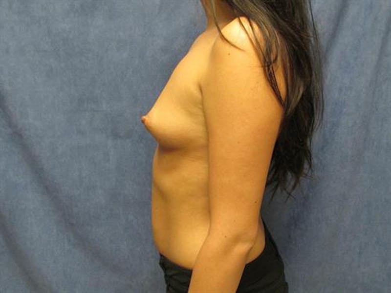 Breast Augmentation Before & After Gallery - Patient 752097 - Image 5