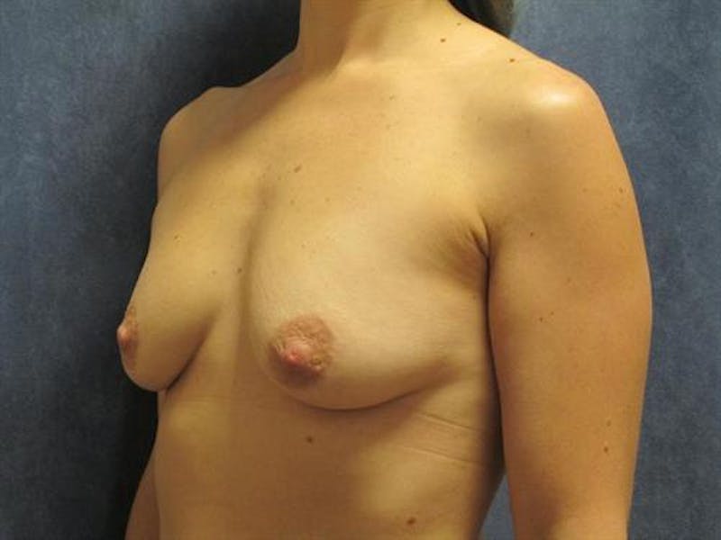 Breast Augmentation Before & After Gallery - Patient 269403 - Image 1