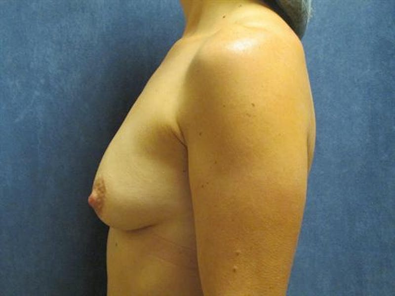 Breast Augmentation Before & After Gallery - Patient 269403 - Image 3