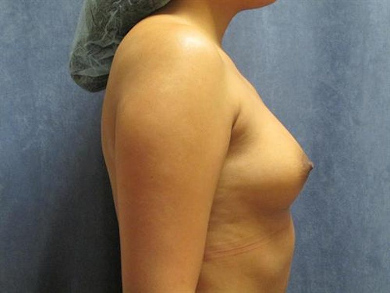 Breast Augmentation Before & After Gallery - Patient 591224 - Image 3