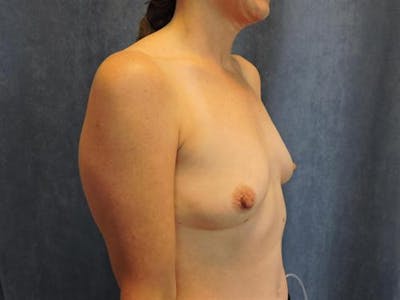 Breast Augmentation Before & After Gallery - Patient 172750 - Image 1