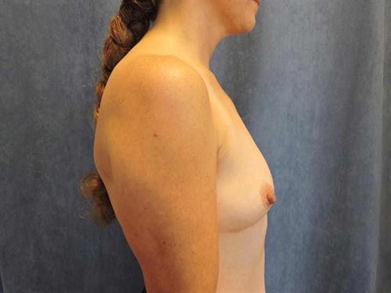 Breast Augmentation Before & After Gallery - Patient 172750 - Image 3