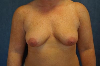 Breast Augmentation Before & After Gallery - Patient 832141 - Image 1