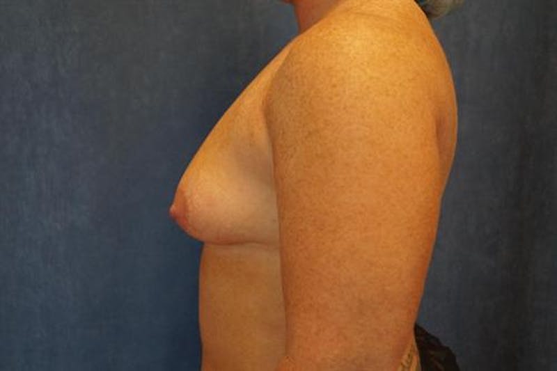 Breast Augmentation Before & After Gallery - Patient 832141 - Image 5