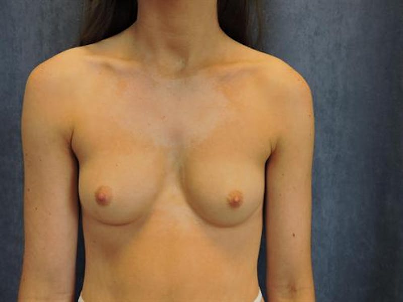 Breast Augmentation Before & After Gallery - Patient 389848 - Image 1