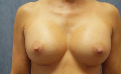 Breast Augmentation Before & After Gallery - Patient 210645 - Image 2
