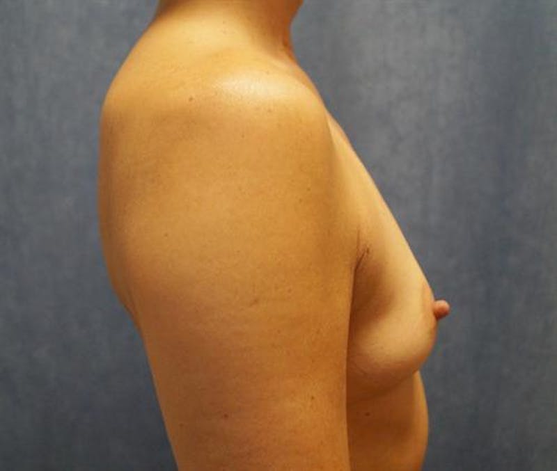 Breast Augmentation Before & After Gallery - Patient 210645 - Image 5