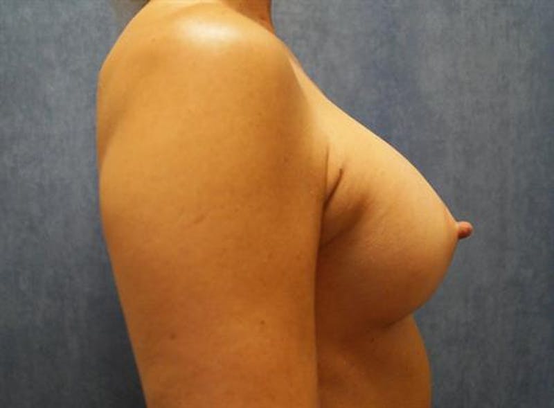 Breast Augmentation Before & After Gallery - Patient 210645 - Image 6