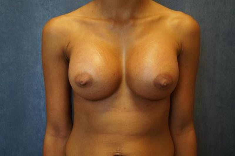 Breast Augmentation Before & After Gallery - Patient 130432 - Image 2