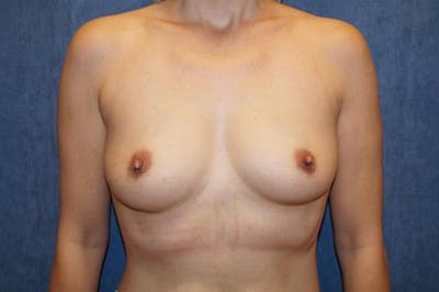 Breast Augmentation Before & After Gallery - Patient 214279 - Image 1