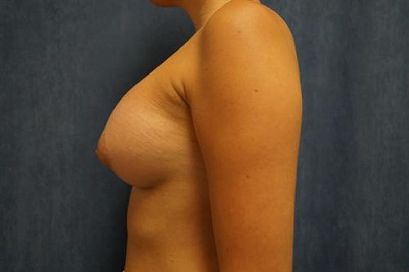 Breast Augmentation Before & After Gallery - Patient 916683 - Image 6