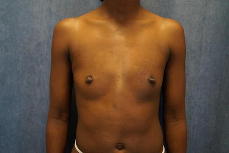 Breast Augmentation Before & After Gallery - Patient 201450 - Image 1