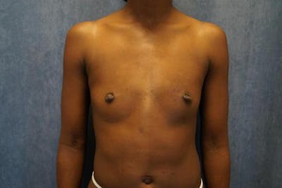 Breast Augmentation Before & After Gallery - Patient 201450 - Image 1