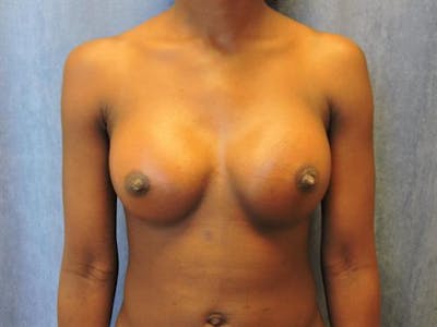 Breast Augmentation Before & After Gallery - Patient 201450 - Image 2